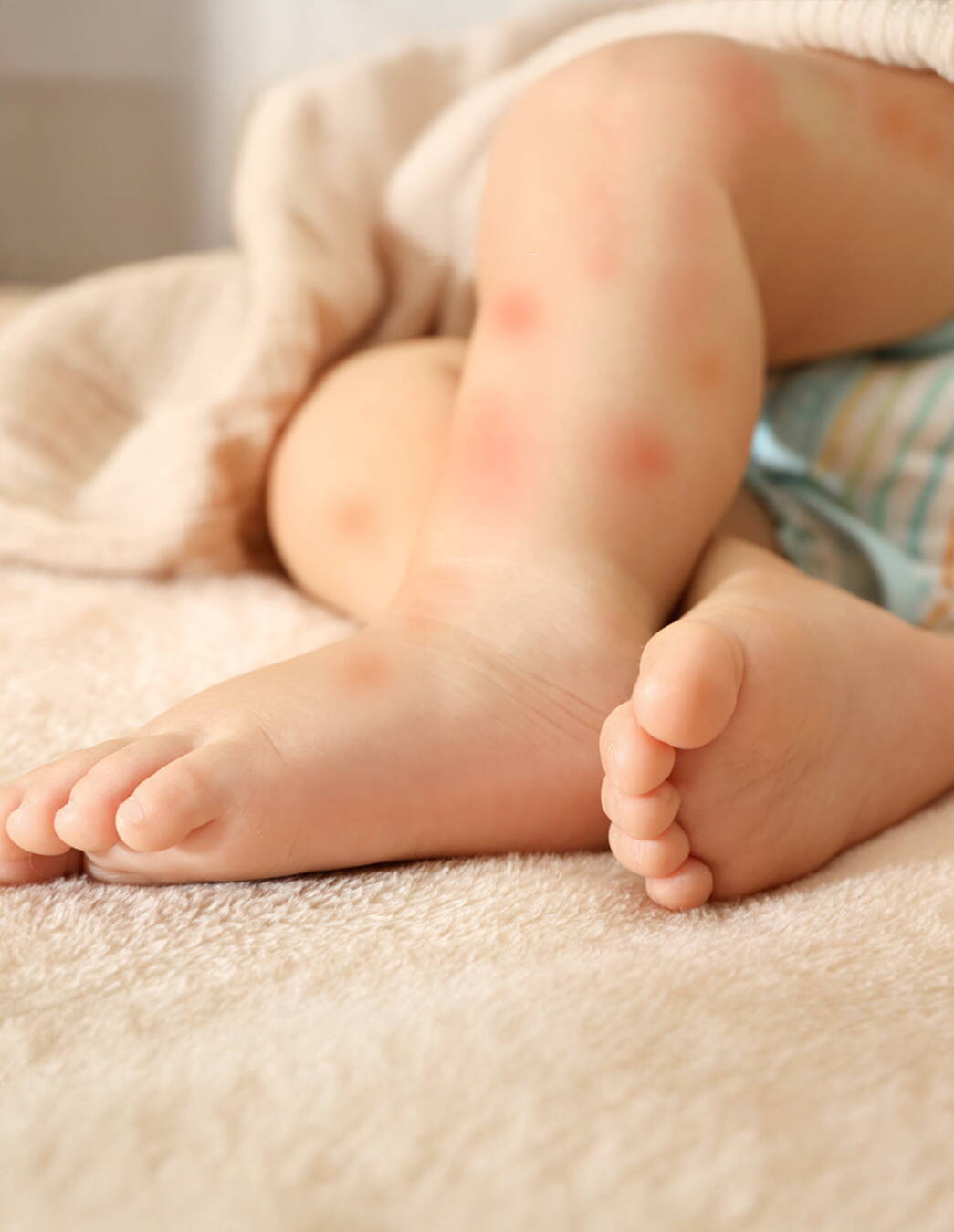 Comment protéger votre enfant contre les piqûres de moustiques Les piqûres de moustiques peuvent rendre la vie difficile aux bébés et aux tout-petits. Découvrez ici comment les prévenir et soulager les symptômes en douceur